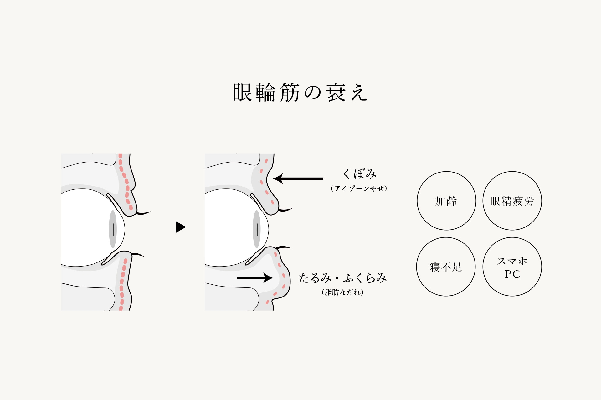 眼輪筋の衰え
